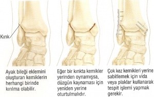 Ayak Bileği Rahatsızlıkları - Şenol Akman